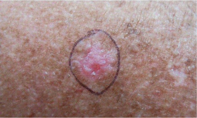 Basal Cell Carcinoma